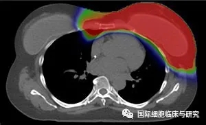 乳腺癌常规放疗辐射剂量分布