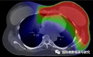 乳腺癌质子治疗辐射剂量分布