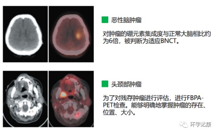 恶性脑瘤头颈部肿瘤硼中子俘获治疗