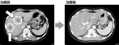 肝癌NK细胞治疗前后