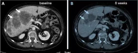 肝转移瘤明显萎缩