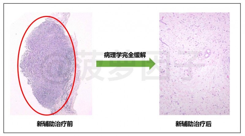 新辅助治疗病理完全缓解对比