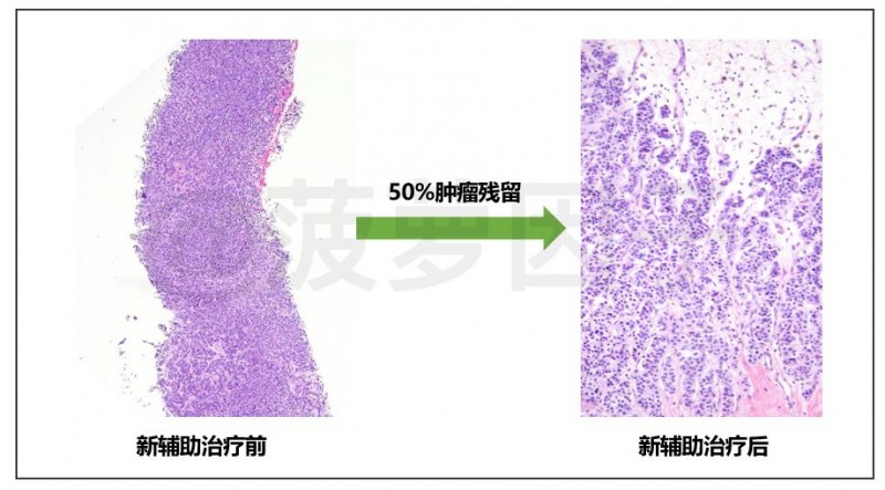 0%肿瘤残留新辅助治疗前后对比