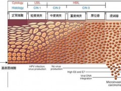 从HPV感染到宫颈癌都经历了什么？