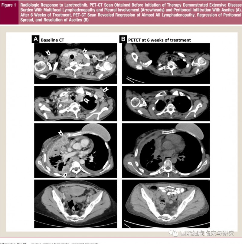 患者治疗前CT及拉罗替尼治疗6周后PETCT对比图