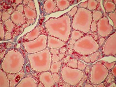 英国NHS批准三种甲状腺癌治疗方法进行常规使用
