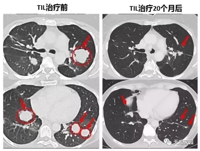 胆管癌TIL治疗前后对比