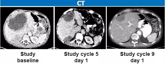 拉罗替尼治疗胃肠间质瘤CT影像对比图
