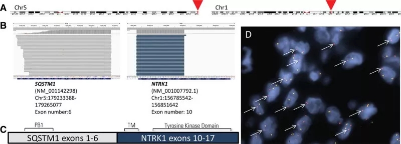 SQSTM1-NTRK1突变