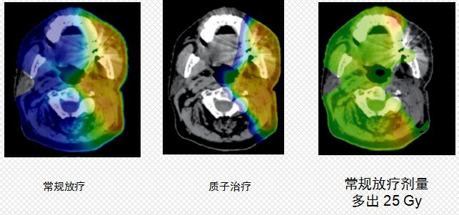 质子治疗和常规放疗放射剂量对比