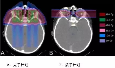 儿童视网膜母细胞瘤光子治疗和质子治疗对比