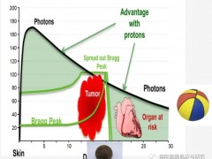 小细胞肺癌放疗,小细胞肺癌质子放疗,小细胞肺癌质子治疗为小细胞肺癌患者带来全新希望