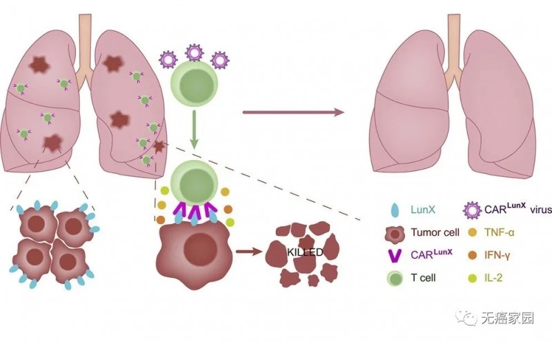 肺癌CAR lunX T 细胞免疫治疗