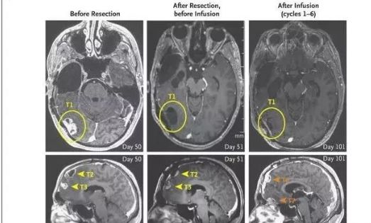 脑瘤CAR-T治疗效果