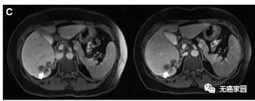 通过MRI观察到患者P10的一个肝脏病变发生萎缩