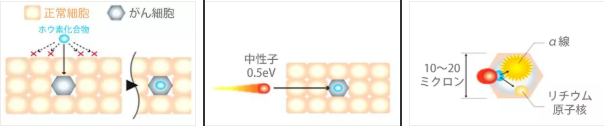 硼中子俘获疗法的治疗流程