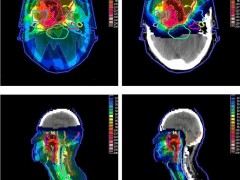 晚期鼻咽癌放疗,鼻咽癌质子放疗,鼻咽癌质子治疗5年生存率74%