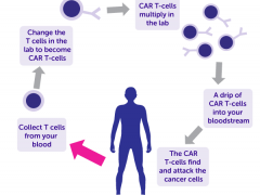 血癌、血液肿瘤、骨髓瘤、非霍奇金淋巴瘤、白血病CAR-T细胞治疗,CART治疗,CART细胞免疫疗法