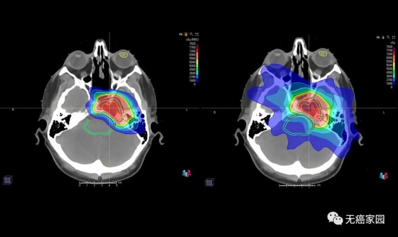 脑瘤质子放疗和传统放疗剂量对比