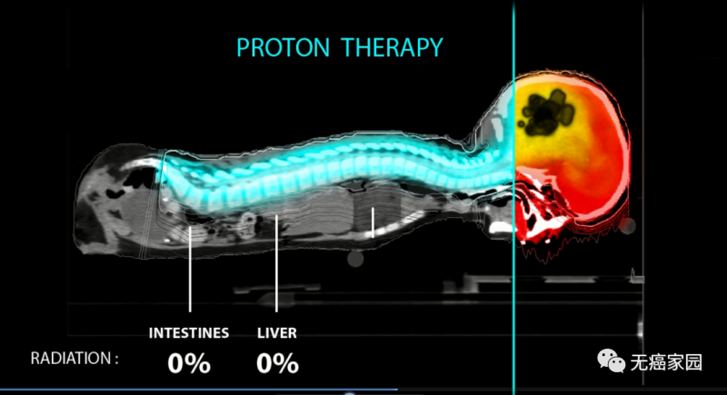 髓母细胞瘤全脑全脊照射质子放疗和传统放疗剂量对比