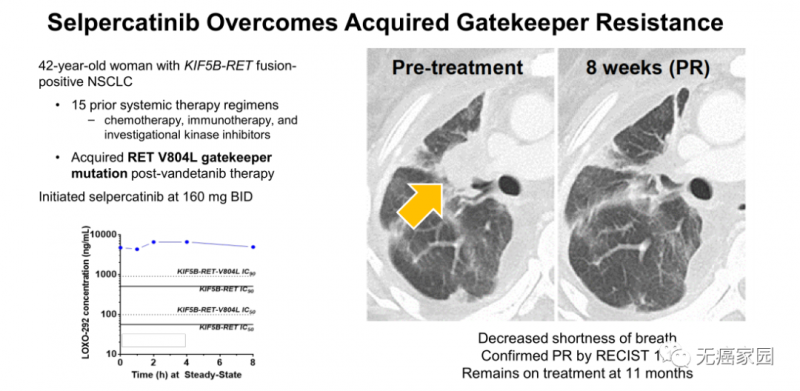 LOXO-292治疗KIF5B-RET融合基因阳性的女性非小细胞肺癌患者