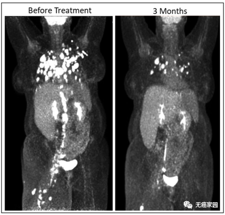 患者治疗前和治疗3个月后的PET-CT结果