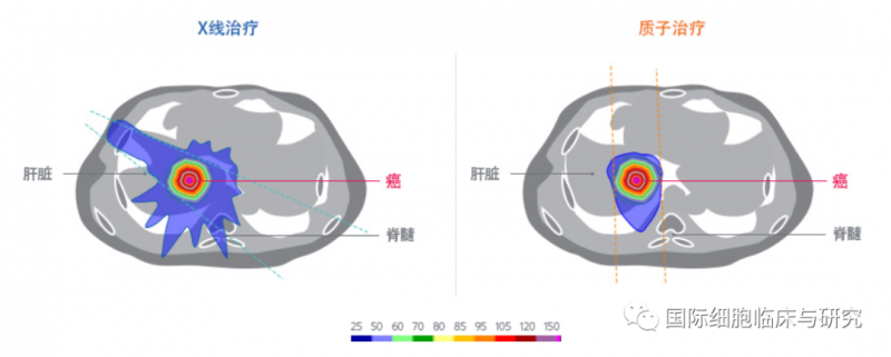 常规光子疗法与质子疗法治疗肝癌的放射剂量比较