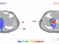 肝癌放疗,肝癌精准放疗,肝癌质子放疗,肝癌质子疗法为患者带来更大生存获益