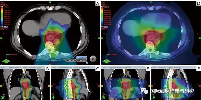 食道癌质子治疗和传统放疗照射范围对比
