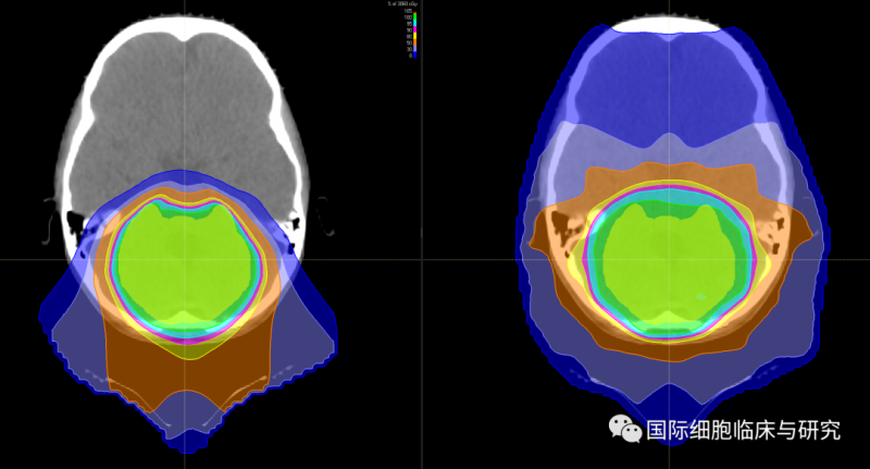 儿童脑瘤质子放疗和光子放疗放射剂量对比