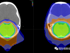 小儿儿童恶性脑瘤质子放疗,脑瘤质子治疗,髓母细胞瘤质子放疗,髓母细胞瘤质子治疗