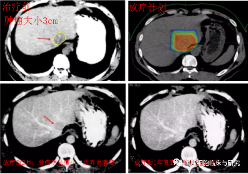 原发性小肝癌三位适形放射治疗