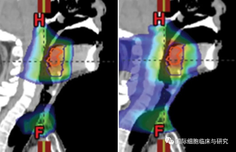 喉癌质子治疗案例
