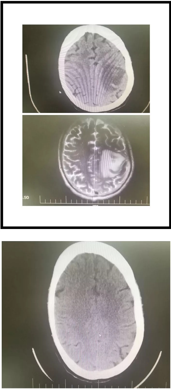 肺癌脑转移治疗前与治疗前后对比