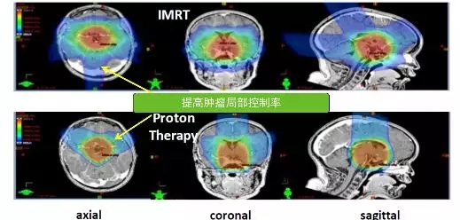 儿童颅咽管瘤质子治疗