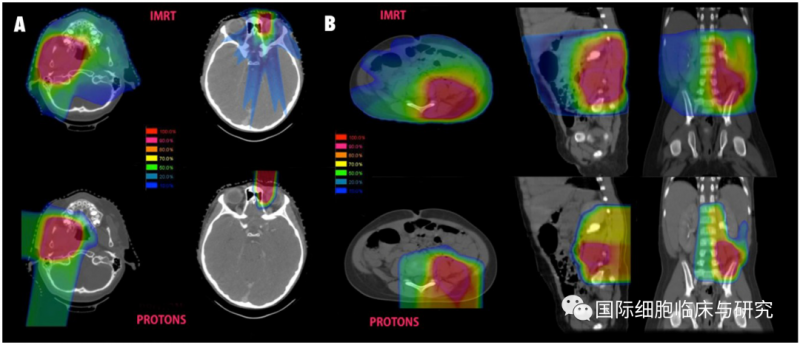 质子治疗和传统放疗放射剂量对比