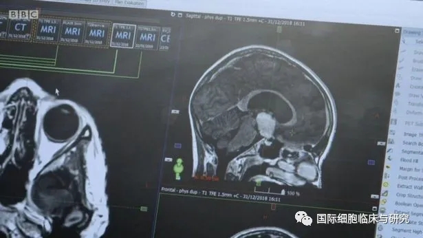 脑瘤影像图
