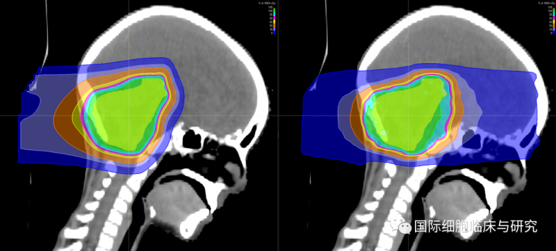 质子治疗和传统放疗放射剂量对比