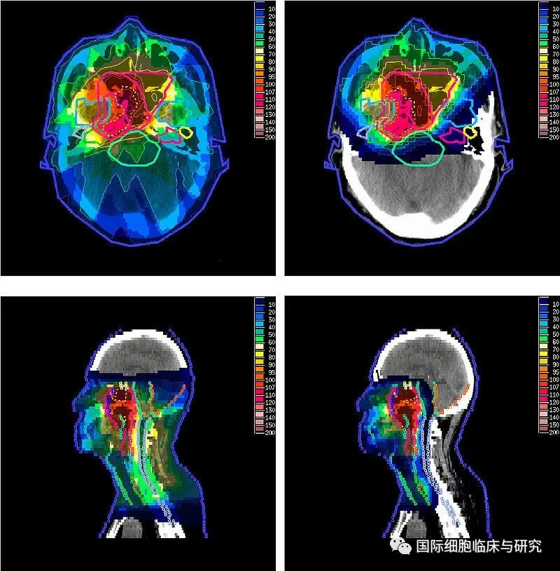 鼻咽癌传统放疗和质子治疗放射范围对比