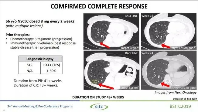 NC318治疗肿瘤完全消失的肺癌患者治疗概况