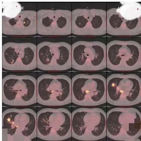 肺癌诊断的PET-CT融合图像