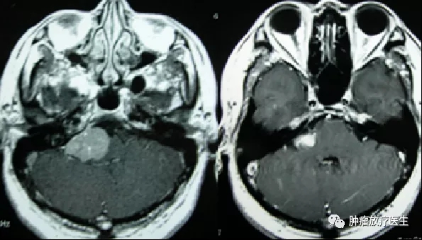 脑膜瘤治疗后2年