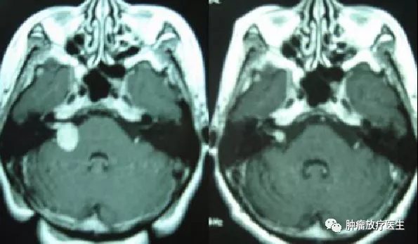 听神经瘤治疗4年