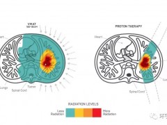 脑干肿瘤症状,脑瘤放疗,脑瘤质子治疗,脑肿瘤放疗,脑肿瘤质子治疗