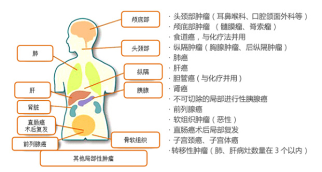 质子治疗适应症