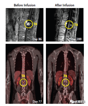 第二轮CAR-T疗法结束后,Richard Grady脊索内肿瘤出现剧烈萎缩