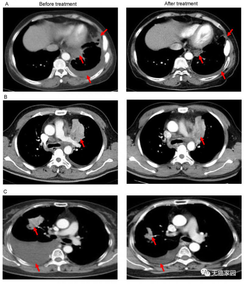 EGFR为靶点的CAR-T治疗晚期难治性非小细胞肺癌治疗案例