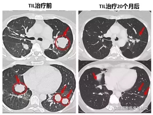 til疗法治疗胆管癌前后对比