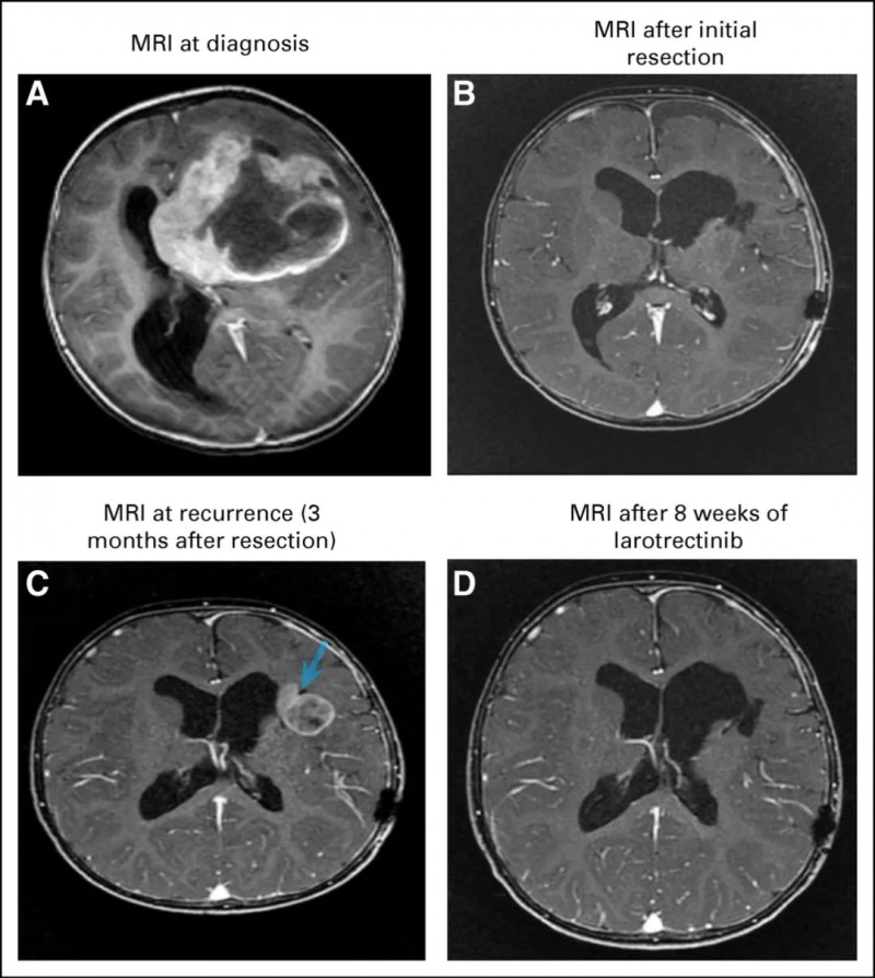 儿童胶质母细胞瘤患者拉罗替尼治疗前后对比