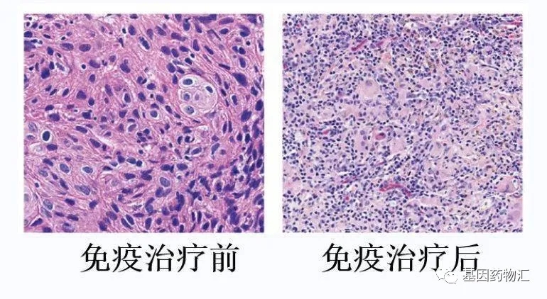 免疫治疗前后对比